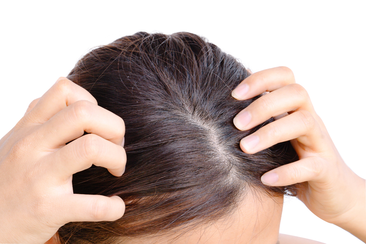 Eczema en el cuero cabelludo? ¿Qué es y cómo se trata? – Salud y